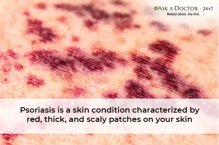 How to Tell If Your Rash is Actually Psoriasis? Learn the Ways to Treat It Naturally!
