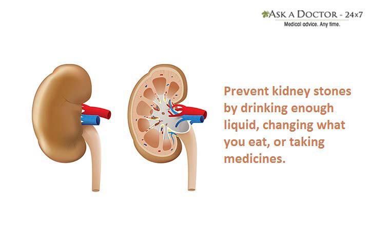 7 Steps Towards Kidney Stone Prevention That You Must Consider!