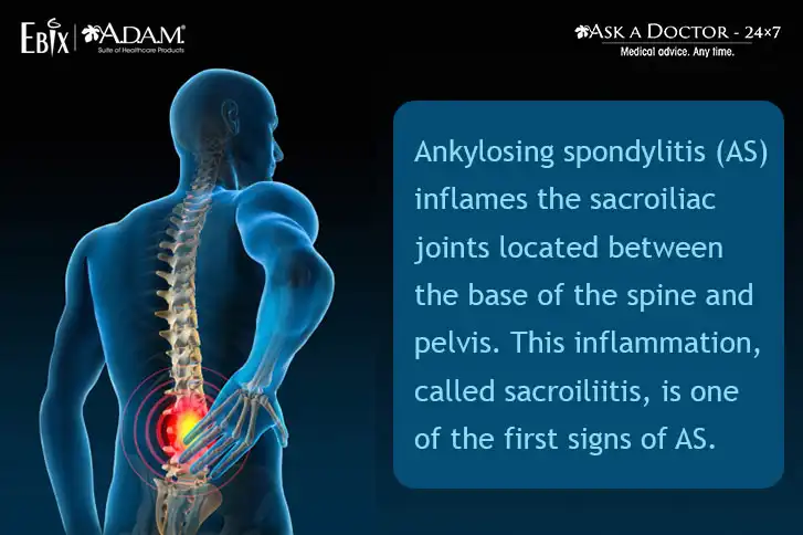 What is Ankylosing Spondylitis, Its Causes and Treatment