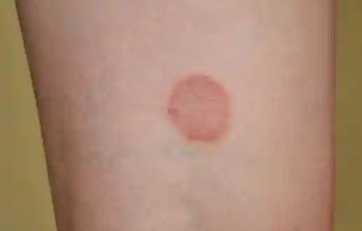 ringworm rash mark in the inner elbow